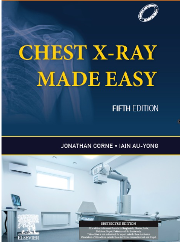 Chest X-Ray Made Easy 5th SAE/2023